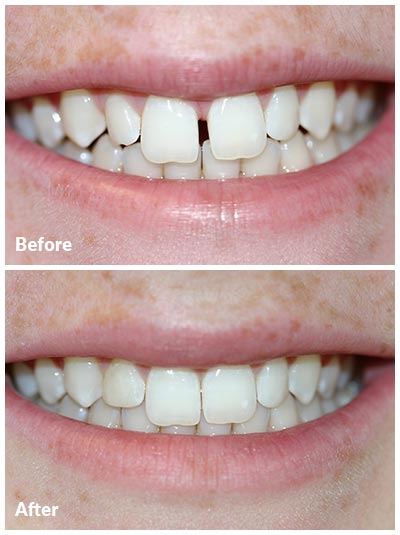 before and after photos of invisalign treatment