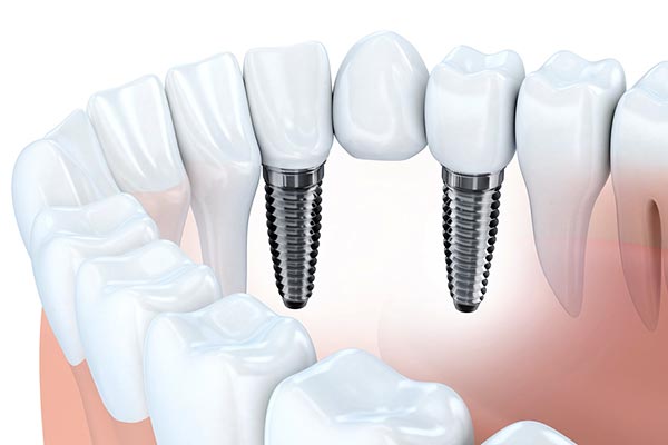 implant supported fixed dental bridge