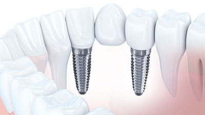 missing teeth replaced with dental implants supporting a dental bridge