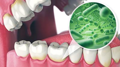 bacteria beneath the gums that can cause periodontal disease