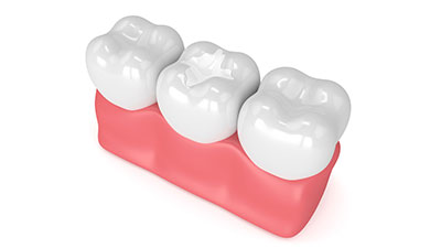 dental sealant tooth coating