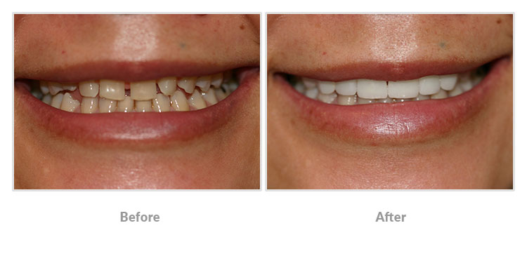 cosmetic dentistry before and after photos