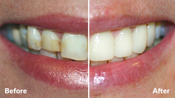 cosmetic dentistry before and after